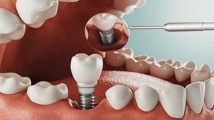 چرا باید ایمپلنت کنیم؟