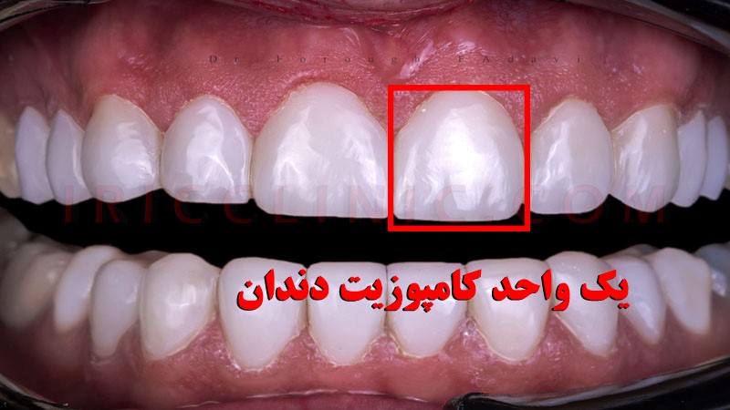 هر واحد کامپوزیت چند دندان است