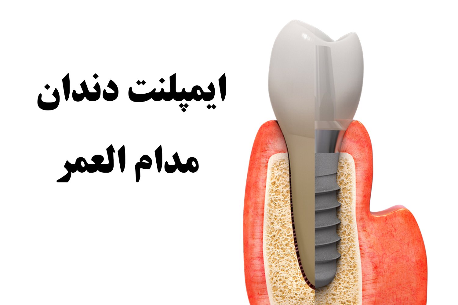 ایمپلنت مادام العمر