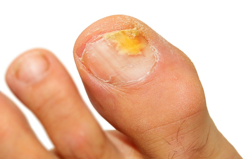 علت قارچ ناخن و لای انگشتان پا چیست؟