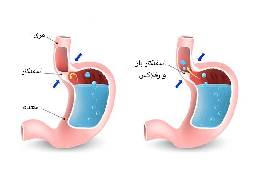 علت رفلاکس معده نوزاد