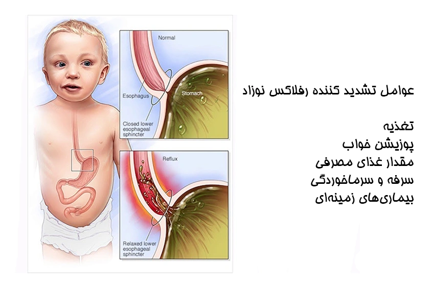 برای رفلاکس معده نوزاد چه باید کرد؟