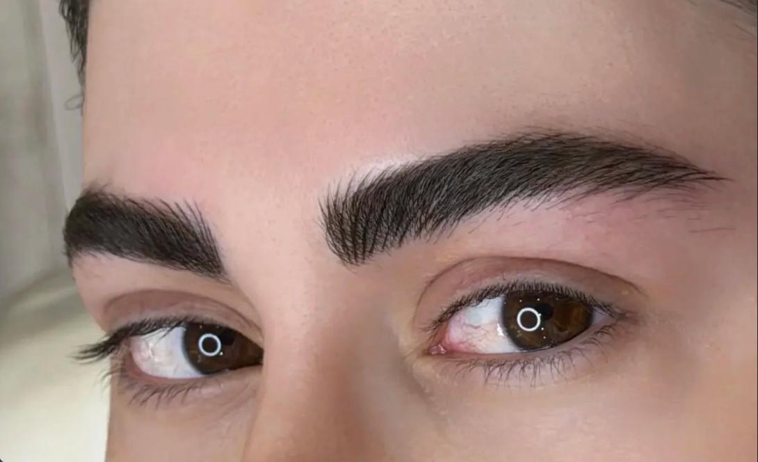 بررسی دقیق تفاوت فیبروز با میکروبلیدینگ